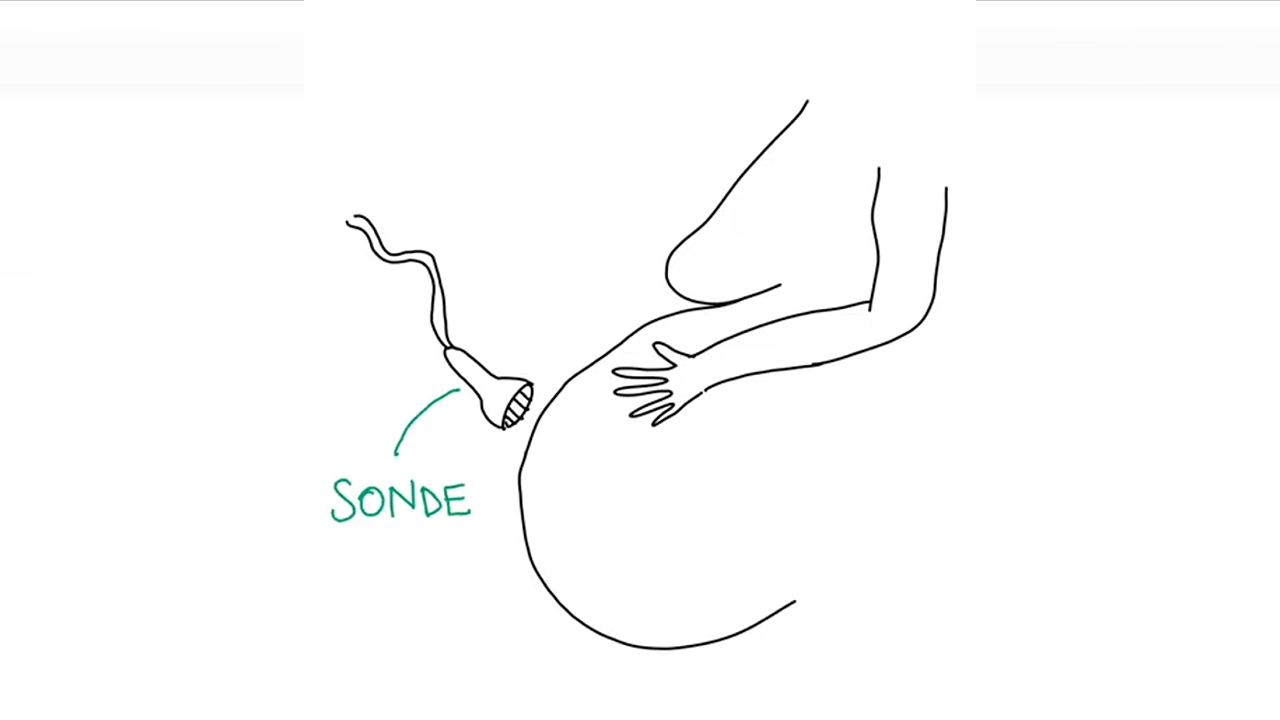 Left profile of an outline of a pregnant woman’s torso and sonograph pointing towards her belly. The word ‘sonde’ written in green with an arrow pointing to the sonograph.